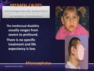 Microcephalus
The intellectual disability
usually ranges from
severe to profound.
There is no specific
treatment and life
expectancy is low.
PRENATAL CAUSES
(Hallahan & Kauffman,2003)
 