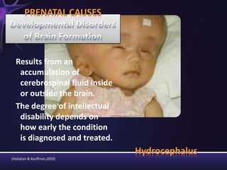 Hydrocephalus
Results from an
accumulation of
cerebrospinal fluid inside
or outside the brain.
The degree of intellectual
disability depends on
how early the condition
is diagnosed and treated.
PRENATAL CAUSES
(Hallahan & Kauffman,2003)
 