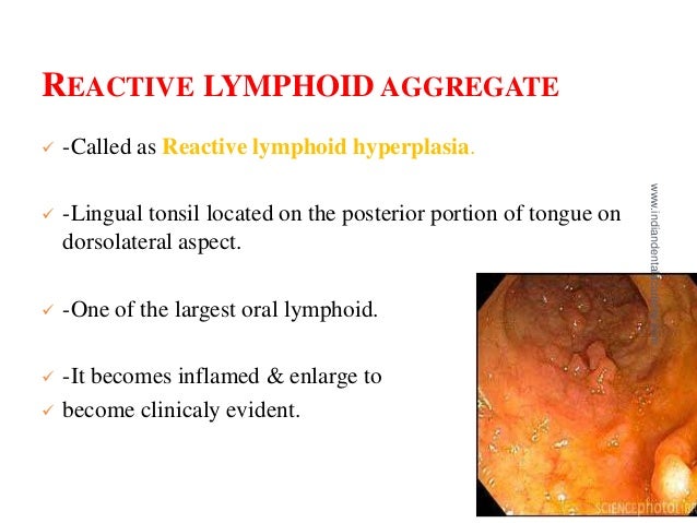 DEVELOPMENTAL DISTURBANCES OF ORAL LYMPHOID TISSUE / dental crown & b…