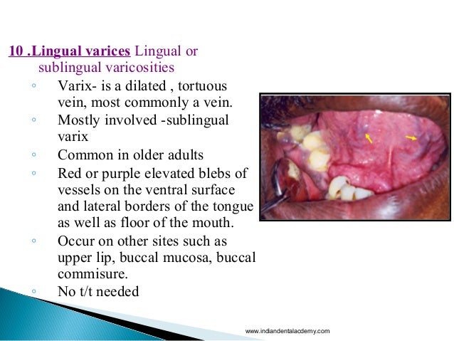 vulvar varicosities home treatment