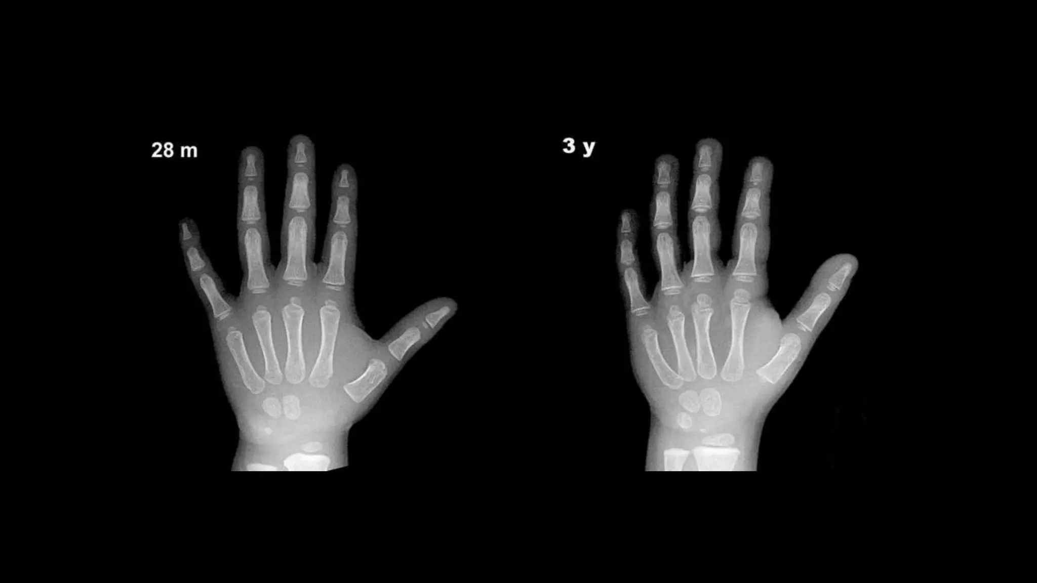 age-estimation-with-x-ray-wrist-joint-pptx