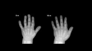 AGE ESTIMATION WITH X RAY WRIST JOINT | PPTX
