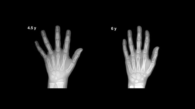 AGE ESTIMATION WITH X RAY WRIST JOINT | PPTX