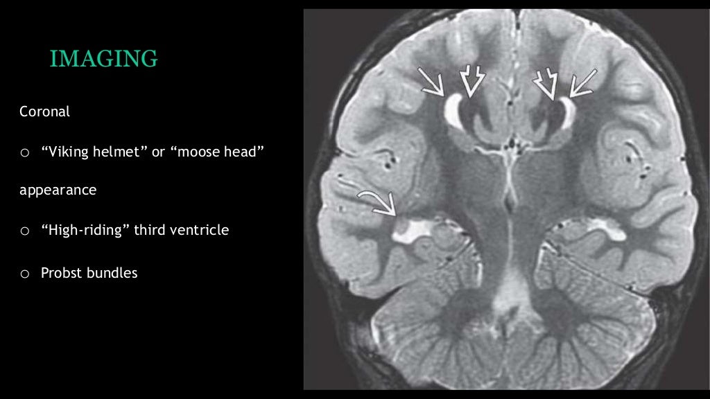 congenital brain anomalies