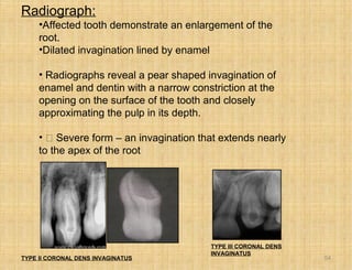 Developmental disturbances ofteeth sem | PPT