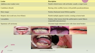 11/7/2023 ashokmourya393@gmail.com 25
Lesion Description
Aphthous ulcer (canker sore) Painful whitish lesion with red border; usually a single lesion
Candidiasis (thrush) Burning white curdlike lesions with peelable pseudomembranes
Hairy tongue Painless blackened raised filiform papillae
Herpetic ulcer (cold sore; fever blister) Painful multiple papules/vesicles; crusting as lesion heals
Leucoplakia Painless white lesions (look like spilled paint or paint flakes);
nonpeelable (precancerous)
Squamous cell carcinoma Ulcerated single indurated lesion with clean raised borders
 