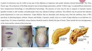 A patch of ecchymosis may be visible on any part of the abdomen on inspection and usually indicates internal hemorrhage. The ‘Grey
Turner sign,’ the ecchymosis of the flank and groin seen in hemorrhagic pancreatitis, and the ‘Cullen's sign,’ is a periumbilical ecchymosis
from retroperitoneal hemorrhage or intra-abdominal hemorrhage. The presence of scars may be due to surgical or traumatic injuries
(gunshot wounds or stab wounds), and pink-purple striae may indicate Cushing's syndrome. Vein dilation may be present that indicates
portal hypertension or vena cava obstruction. ‘Caput Medusa’ that are distended veins flowing away from the umbilicus, have a 90%
specificity in detecting hepatic cirrhosis. Sinuses and fistulae, if present, usually occur as a result of deep infection or an infection of a
surgical tract. If a stoma is identified, various features should be noted to identify the type of stoma. These include the size and appearance
of the stoma and the contents of the stoma bag.
11/7/2023 ashokmourya393@gmail.com 35
 