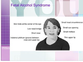 Fetal Alcohol Syndrome  