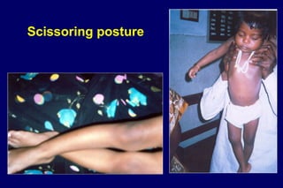 Scissoring posture
 