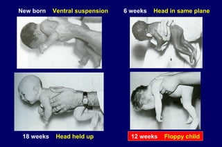 New born Ventral suspension 6 weeks Head in same plane
18 weeks Head held up 12 weeks Floppy child12 weeks Floppy child
 