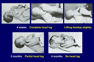 4 weeks Complete head lag
2 months Partial head lag 4 months No head lag
Lifting headup slightly
 