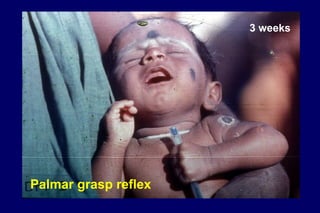 3 weeks
Palmar grasp reflex
 
