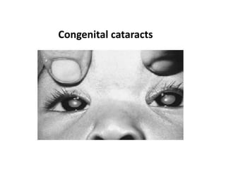 Development Of Eye by Tauqeer Ahmad | PPTX
