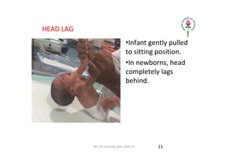 IAP UG Teaching slides 2015‐16
  HEAD LAG
•Infant gently pulled 
to sitting position. 
•In newborns, head 
completely lags 
behind.
11
 