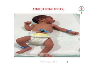 IAP UG Teaching slides 2015‐16
ATNR (FENCING REFLEX)
5
 