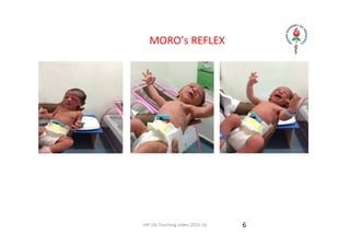 IAP UG Teaching slides 2015‐16
         MORO’s REFLEX
6
 