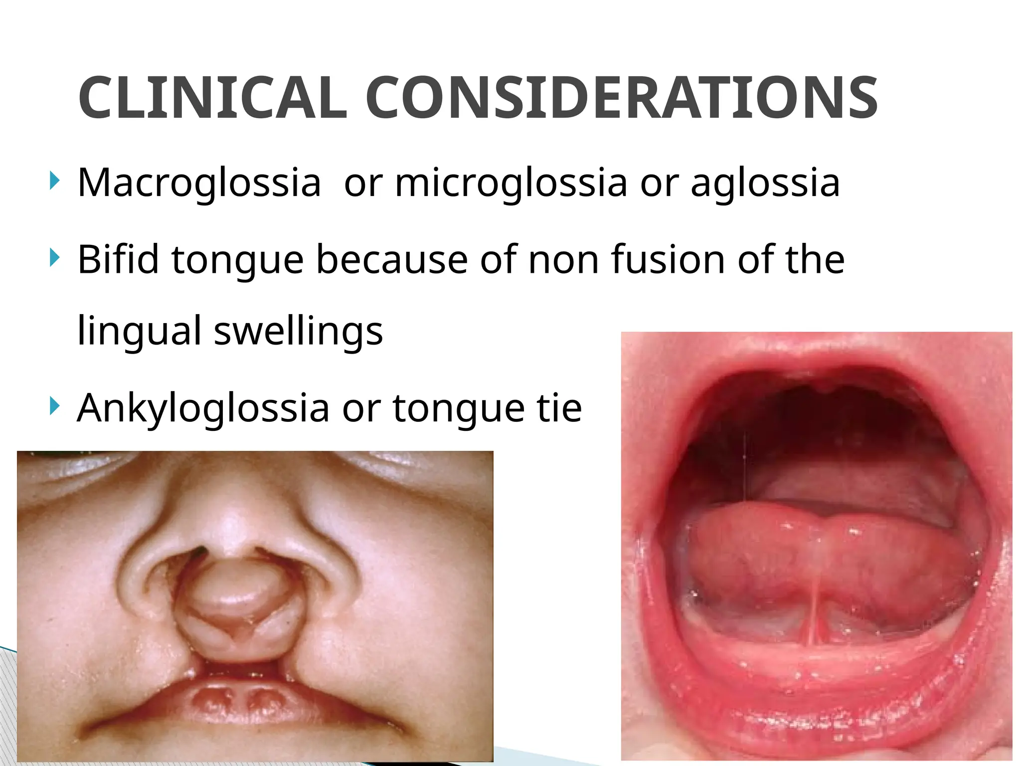  Macroglossia or microglossia or aglossia
 Bifid tongue because of non fusion of the
lingual swellings
 Ankyloglossia or tongue tie
CLINICAL CONSIDERATIONS
 