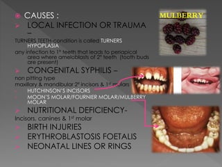 Developmental anomalies of teeth - by variyta | PPTX