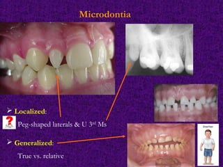 Micro Tooth Oral Developmental anomalies | PPT