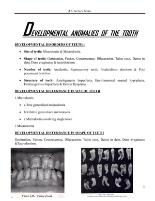 A.C. Lecture Series




     D     EVELOPMENTAL ANOMALIES OF THE TOOTH
DEVELOPMENTAL DISORDERS OF TEETH :

    Size of teeth: Microdontia & Macrodontia.

    Shape of teeth: Gemination, Fusion, Concrescence, Dilaceration, Talon cusp, Dense in
     dent, Dens evaginatus & taurodontism.

    Number of teeth: Anodontia, Supernumery teeth, Predecidious dentition & Post
     permanent dentition.

    Structure of teeth: Amelogenesis Imperfecta, Environmental enamel hypoplasia,
     Dentinogenisis Imperfecta & Dentin Dysplasia.

DEVELOPMENTAL DISTURBANCE IN SIZE OF TEETH

1.Microdontia

    a.True generalized microdontia

    b.Relative generalized microdontia

    c.Microdontia involving single tooth.

2.Macrodontia

DEVELOPMENTAL DISTURBANCE IN SHAPE OF TEETH

Gemination, Fusion, Concrescence, Dilaceration, Talon cusp, Dense in dent, Dens evaginatus
&Taurodontism.




                                                                                        1
 