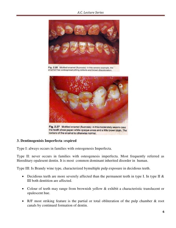 Developmental anomalies of the tooth