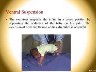 Ventral Suspension
• The examiner suspends the infant in a prone position by
supporting the abdomen of the baby on his palm. The
extension of neck and flexion of the extremities is observed.

 