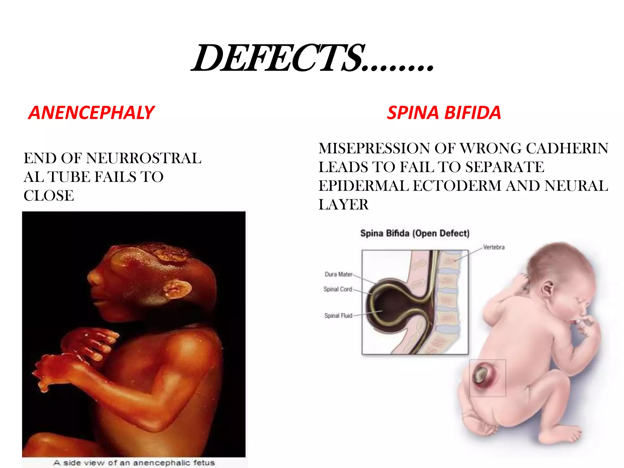 DEFECTS……..
ANENCEPHALY SPINA BIFIDA
END OF NEURROSTRAL
AL TUBE FAILS TO
CLOSE
MISEPRESSION OF WRONG CADHERIN
LEADS TO FAIL TO SEPARATE
EPIDERMAL ECTODERM AND NEURAL
LAYER