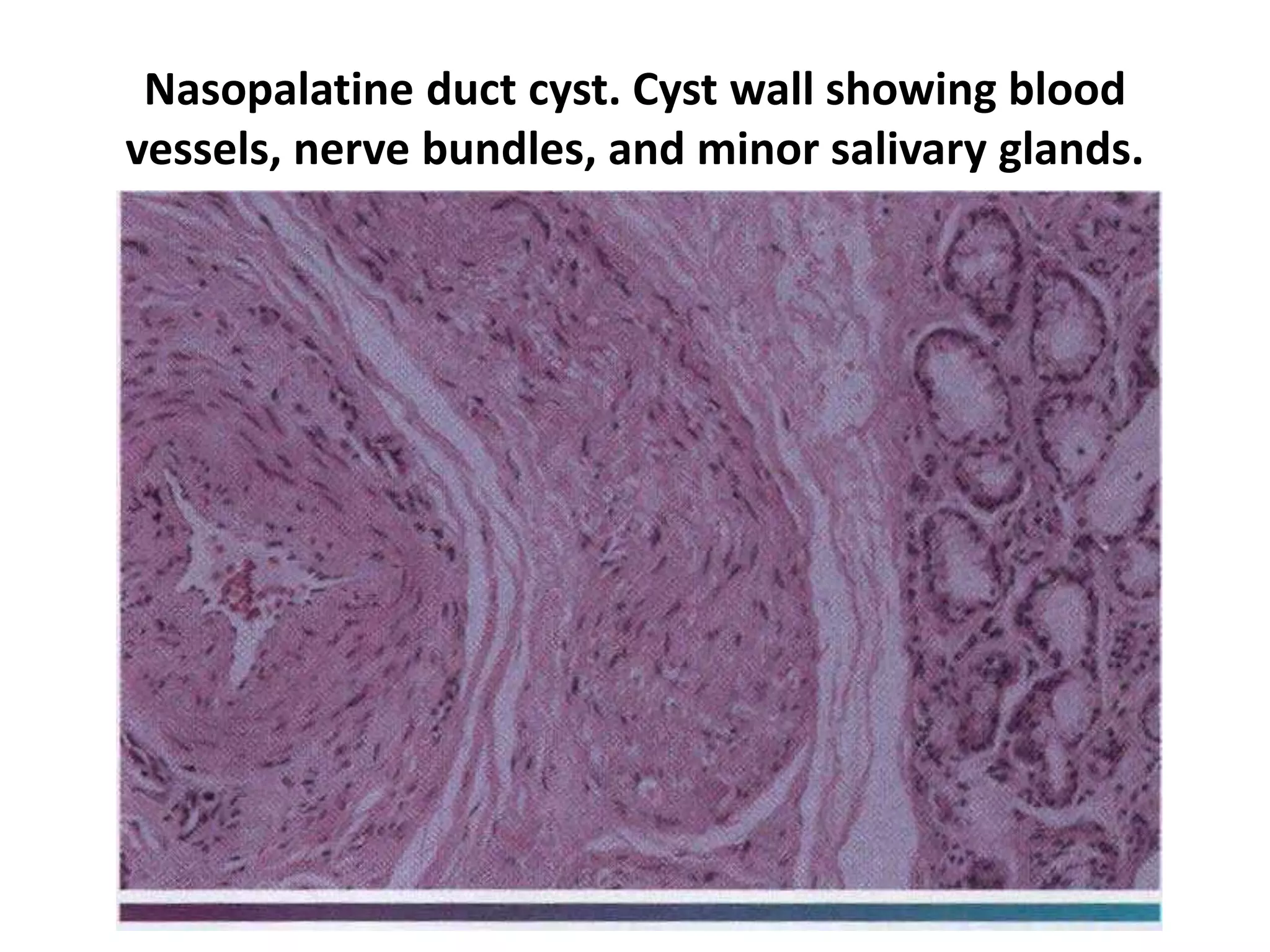 Nasopalatine duct cyst. Cyst wall showing blood
vessels, nerve bundles, and minor salivary glands.
 