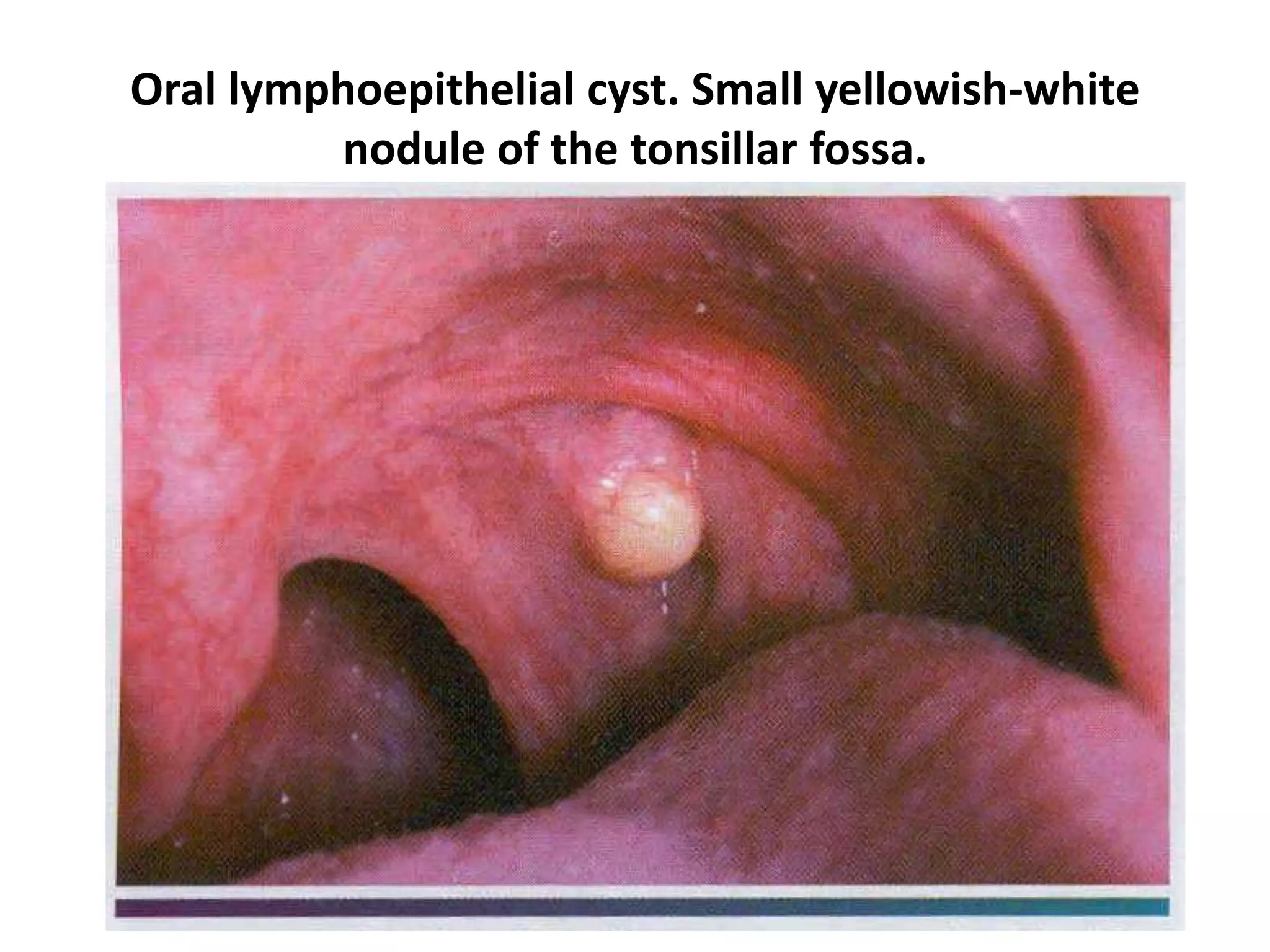 Oral lymphoepithelial cyst. Small yellowish-white
nodule of the tonsillar fossa.
 