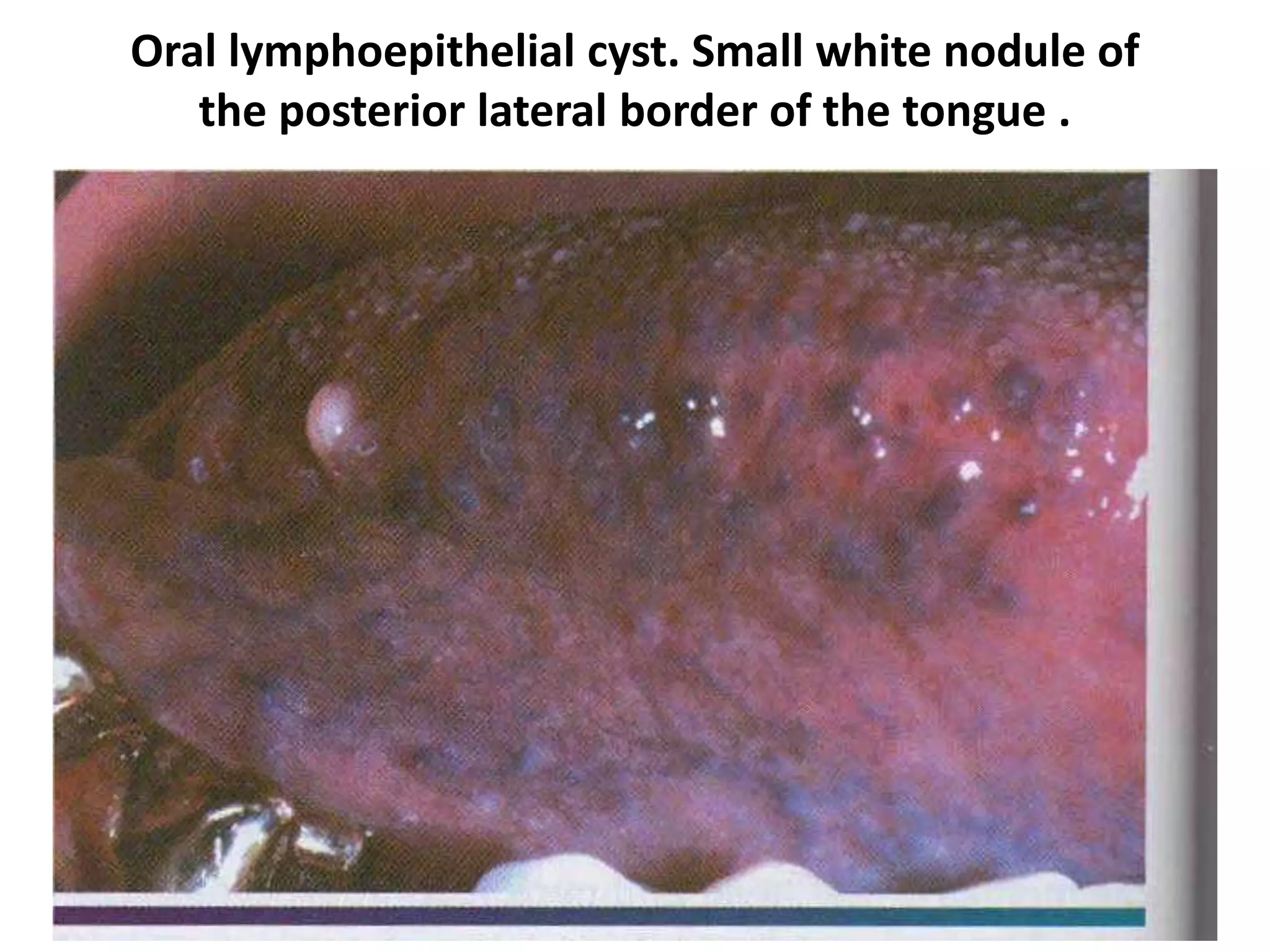 Oral lymphoepithelial cyst. Small white nodule of
the posterior lateral border of the tongue .
 