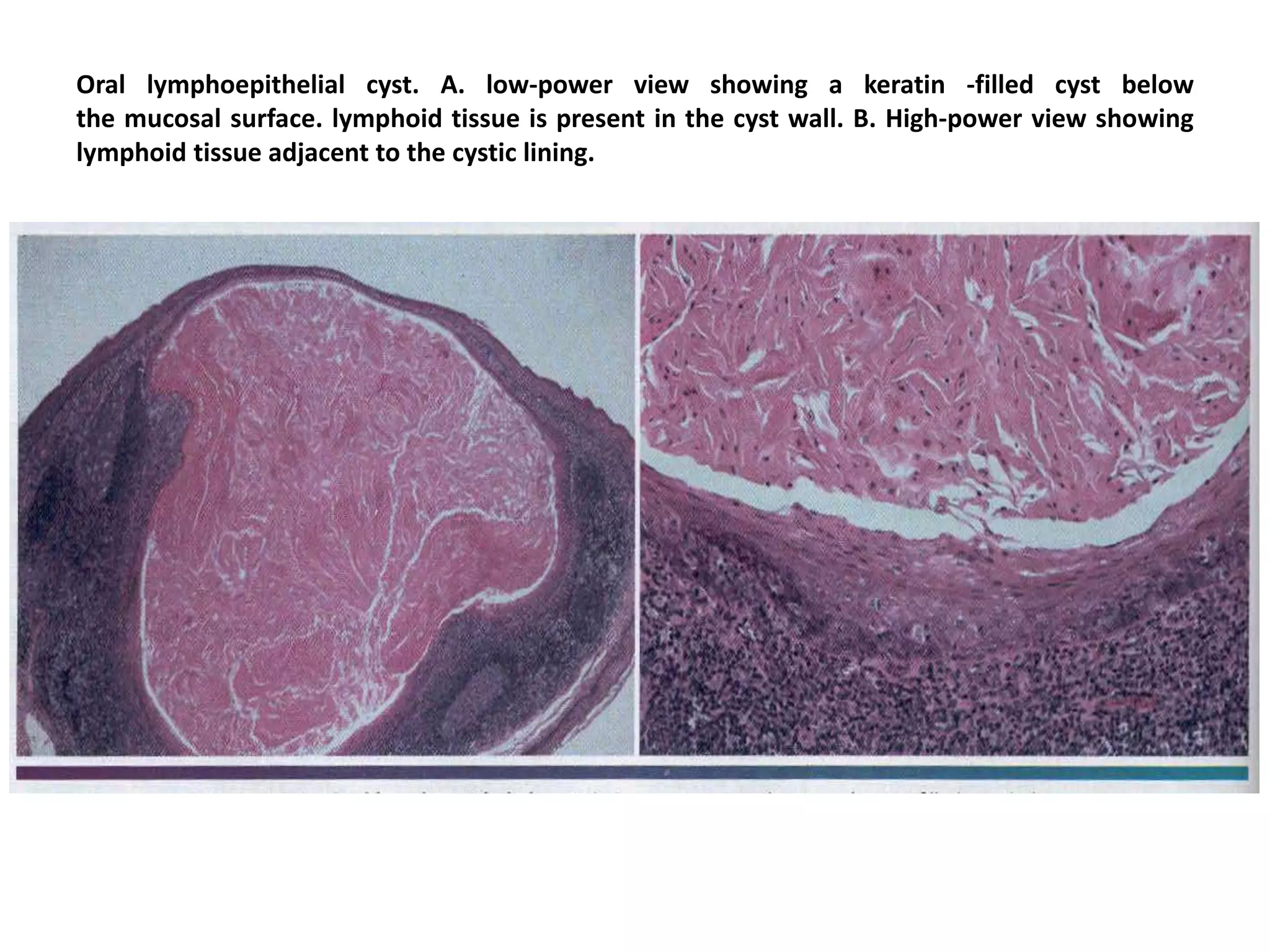 Oral lymphoepithelial cyst. A. low-power view showing a keratin -filled cyst below
the mucosal surface. lymphoid tissue is present in the cyst wall. B. High-power view showing
lymphoid tissue adjacent to the cystic lining.
 