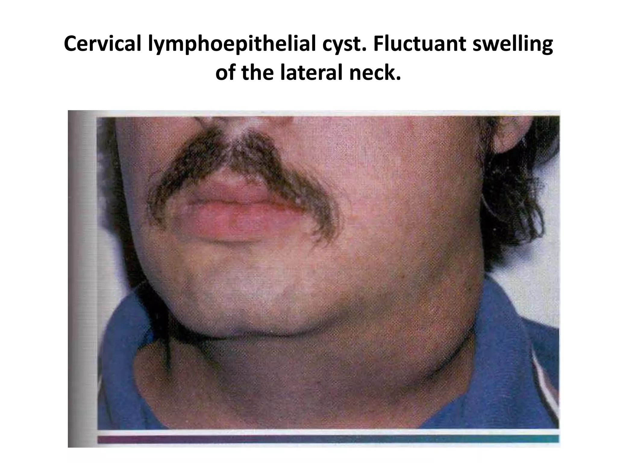 Cervical lymphoepithelial cyst. Fluctuant swelling
of the lateral neck.
 