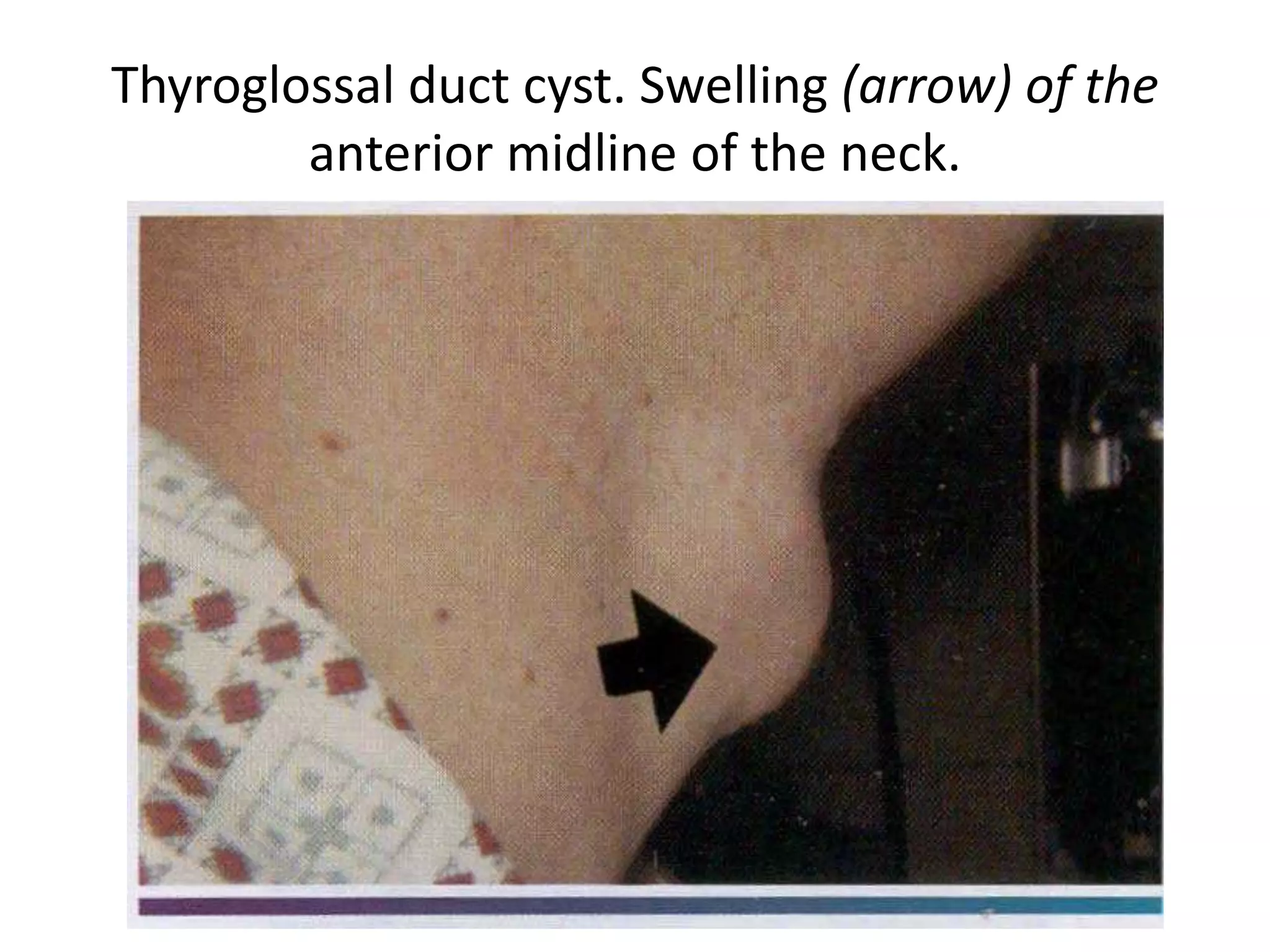 Thyroglossal duct cyst. Swelling (arrow) of the
anterior midline of the neck.
 