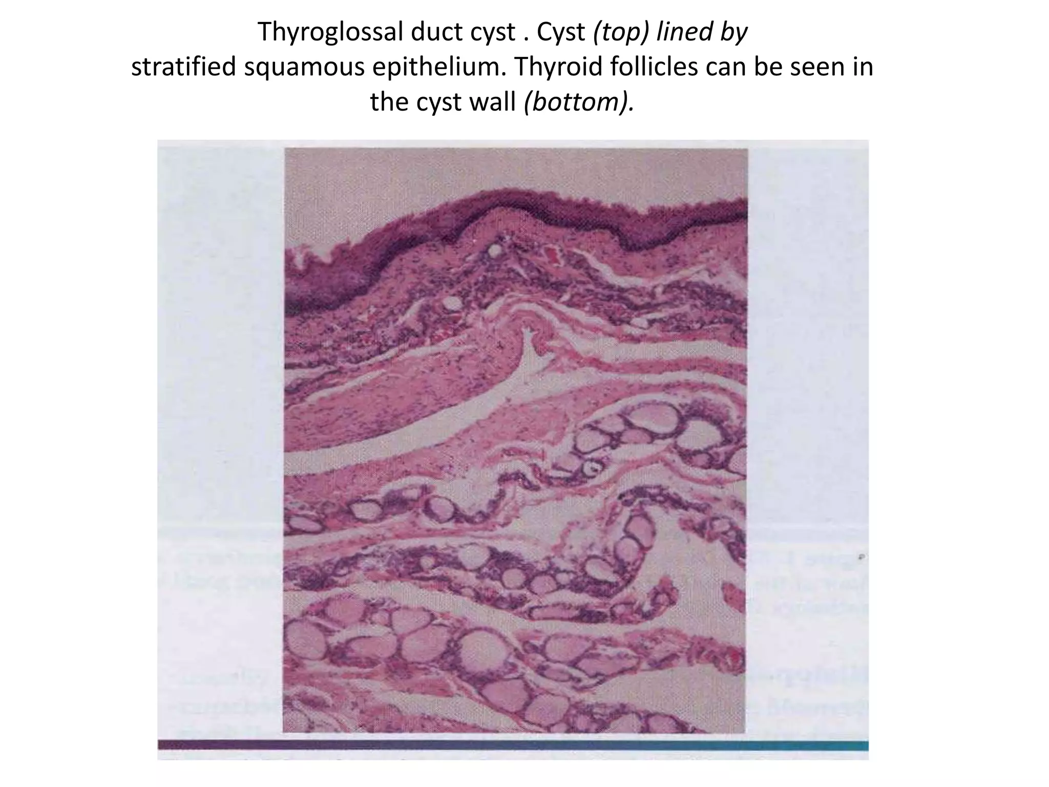 Thyroglossal duct cyst . Cyst (top) lined by
stratified squamous epithelium. Thyroid follicles can be seen in
the cyst wall (bottom).
 