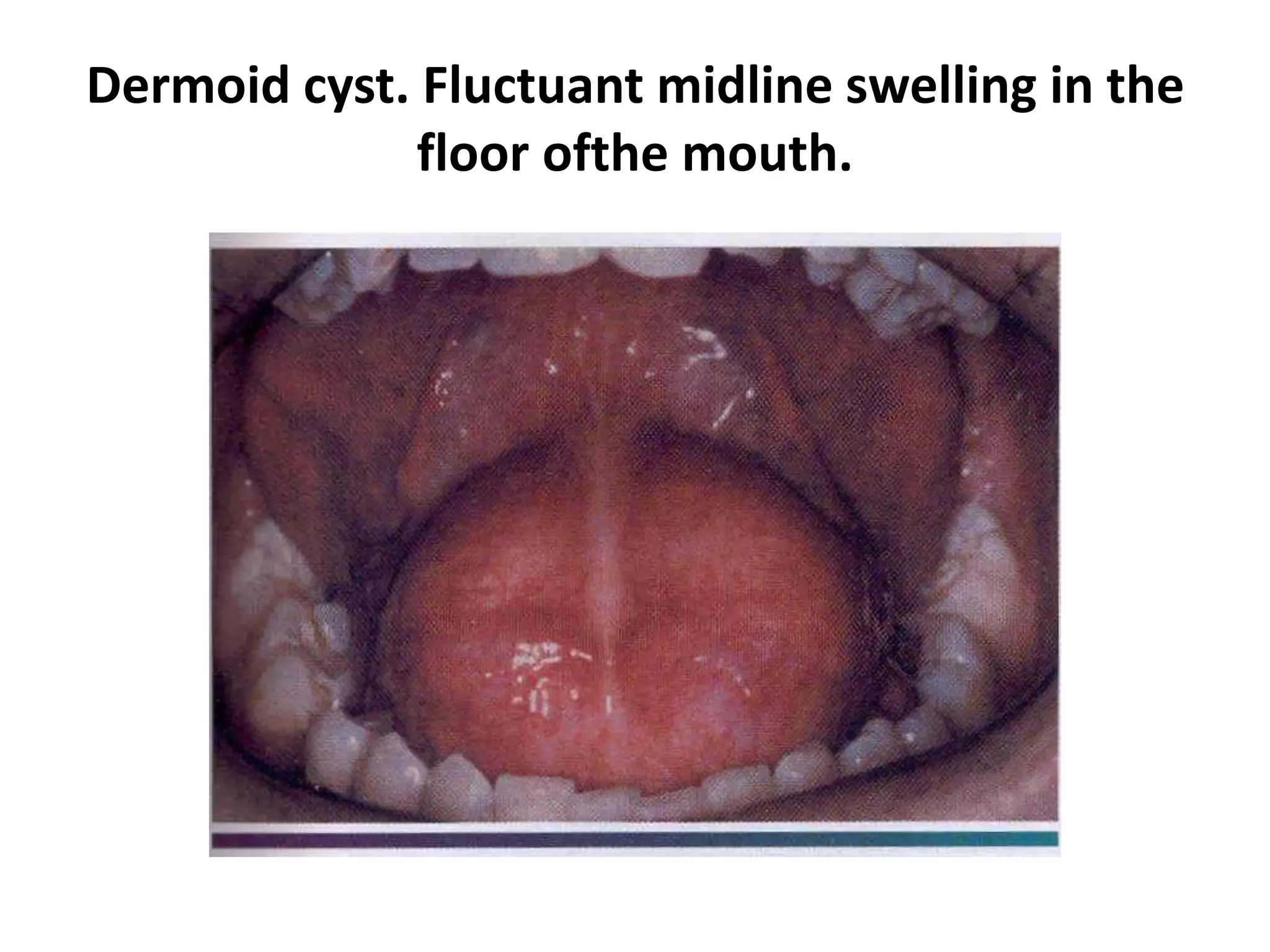 Dermoid cyst. Fluctuant midline swelling in the
floor ofthe mouth.
 