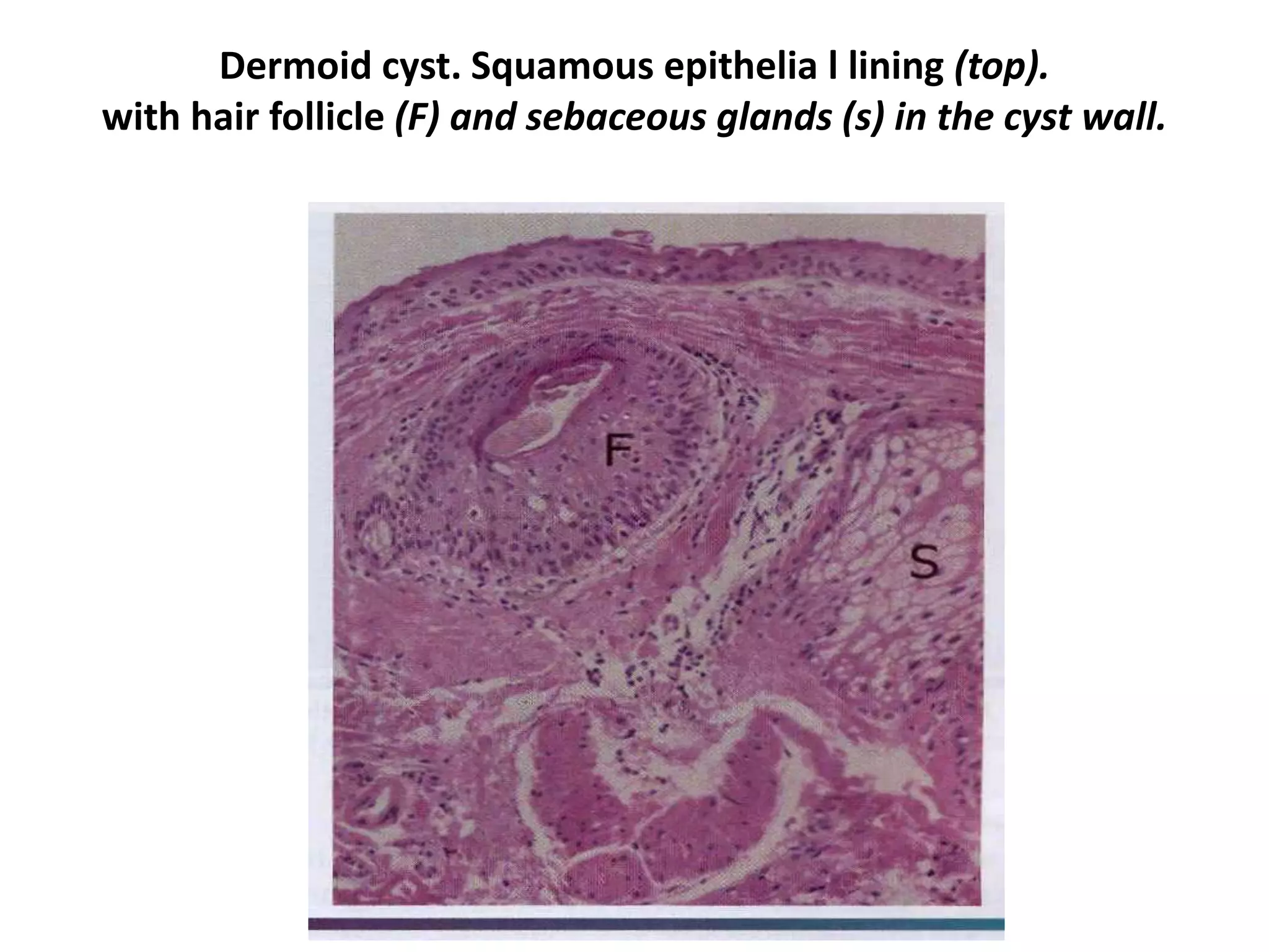Dermoid cyst. Squamous epithelia l lining (top).
with hair follicle (F) and sebaceous glands (s) in the cyst wall.
 