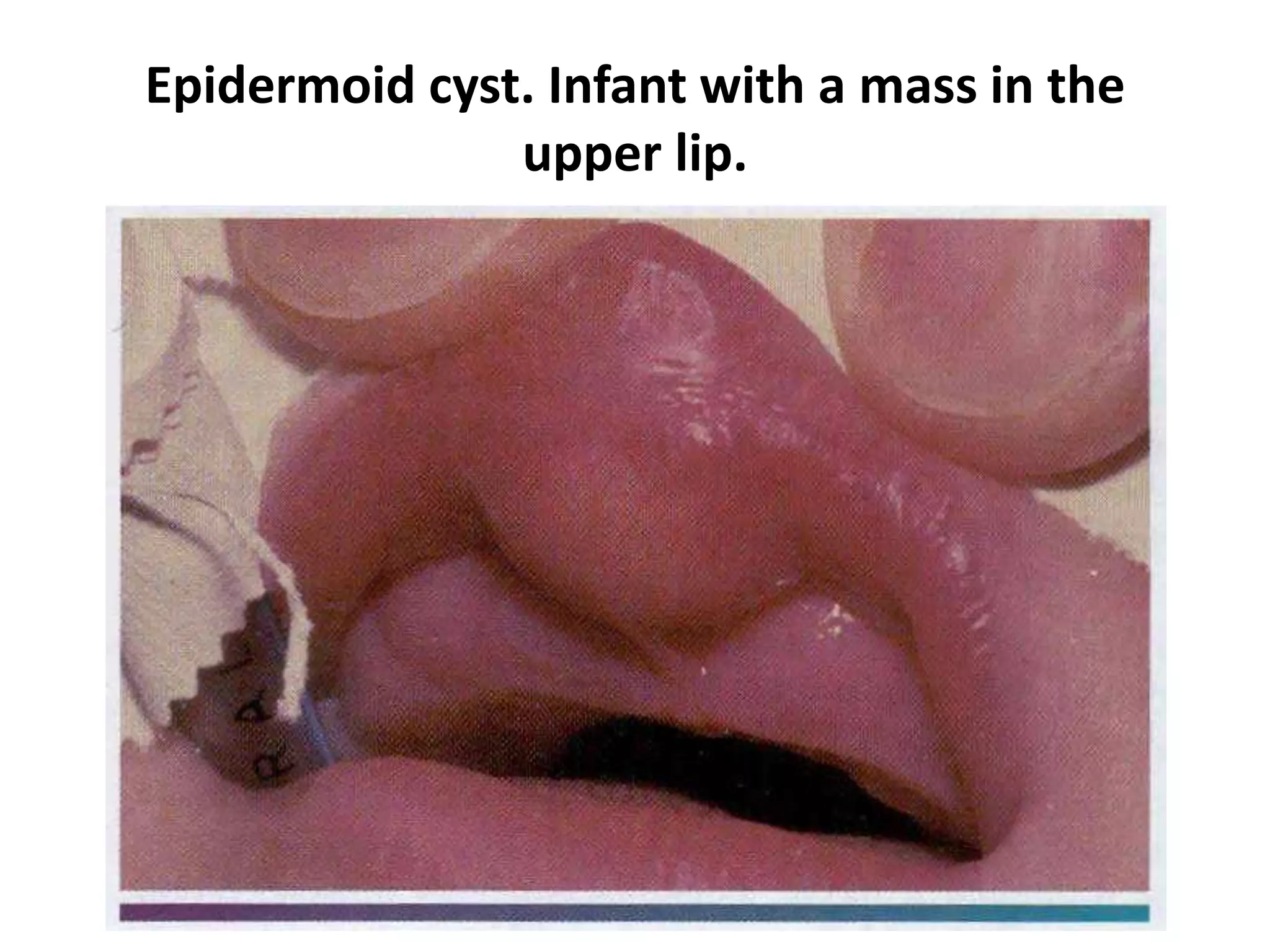 Epidermoid cyst. Infant with a mass in the
upper lip.
 