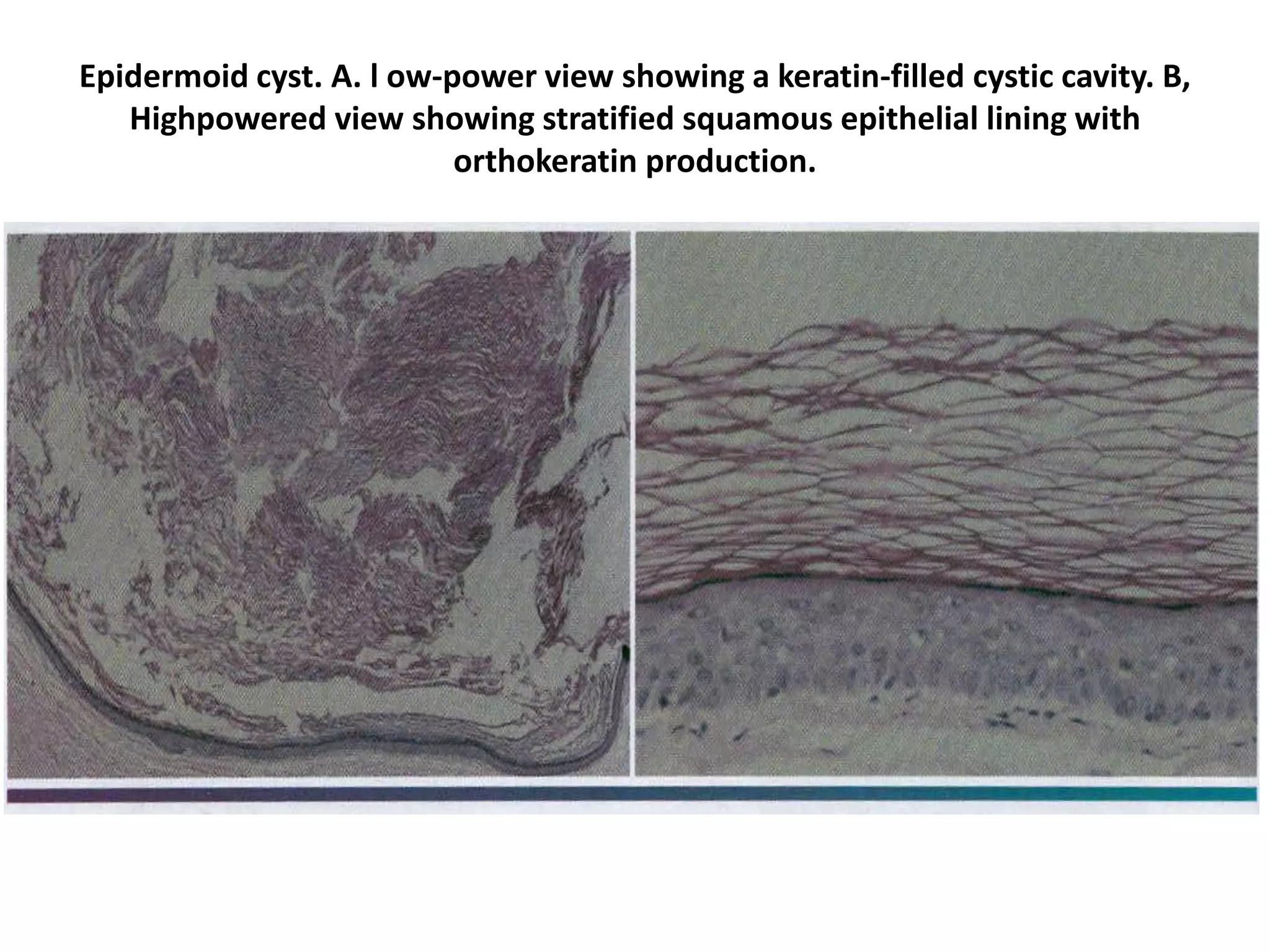 Epidermoid cyst. A. l ow-power view showing a keratin-filled cystic cavity. B,
Highpowered view showing stratified squamous epithelial lining with
orthokeratin production.
 