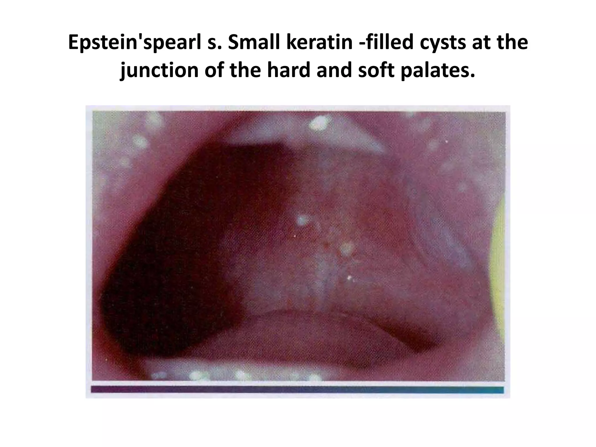 Epstein'spearl s. Small keratin -filled cysts at the
junction of the hard and soft palates.
 