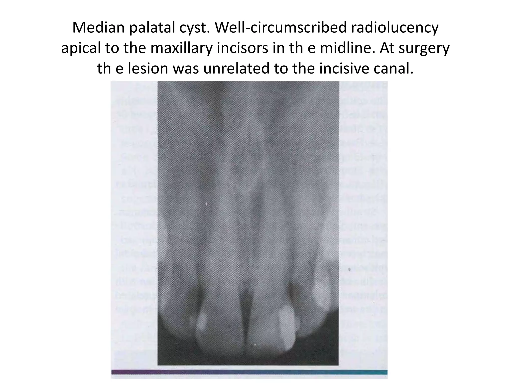 Median palatal cyst. Well-circumscribed radiolucency
apical to the maxillary incisors in th e midline. At surgery
th e lesion was unrelated to the incisive canal.
 