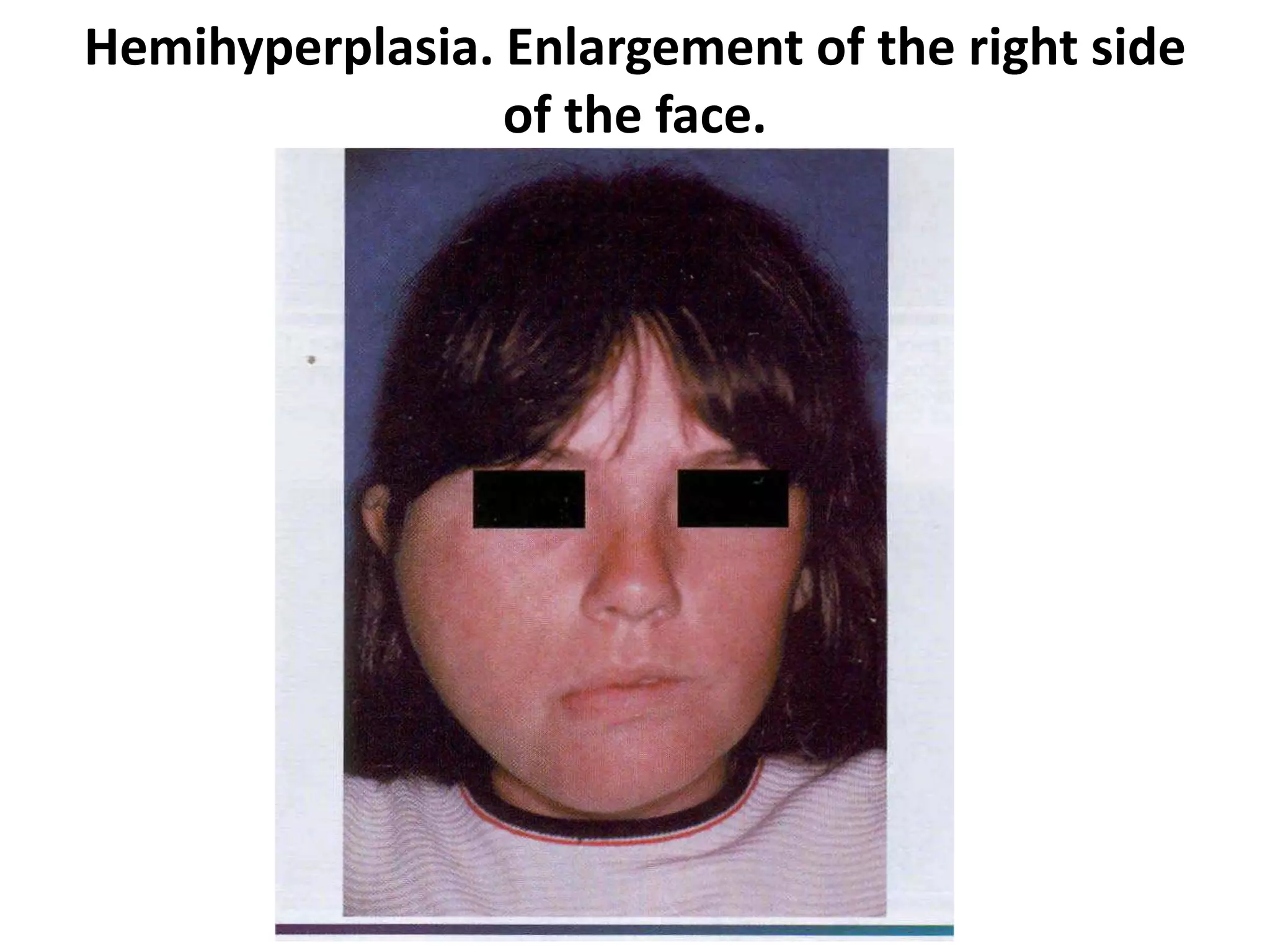 Hemihyperplasia. Enlargement of the right side
of the face.
 