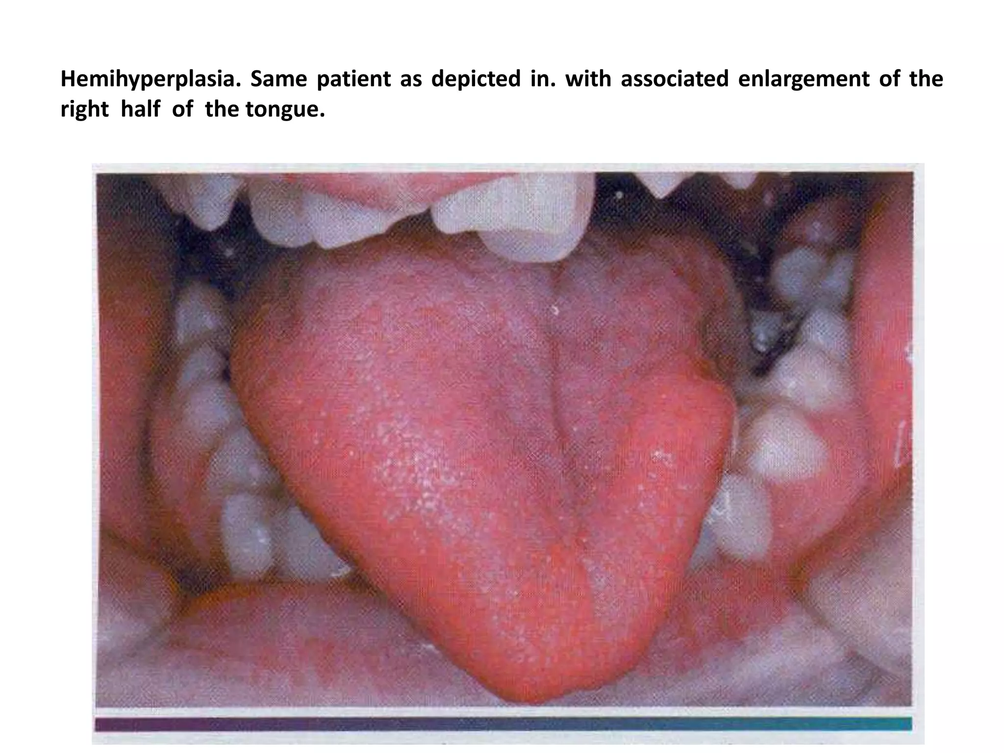 Hemihyperplasia. Same patient as depicted in. with associated enlargement of the
right half of the tongue.
 