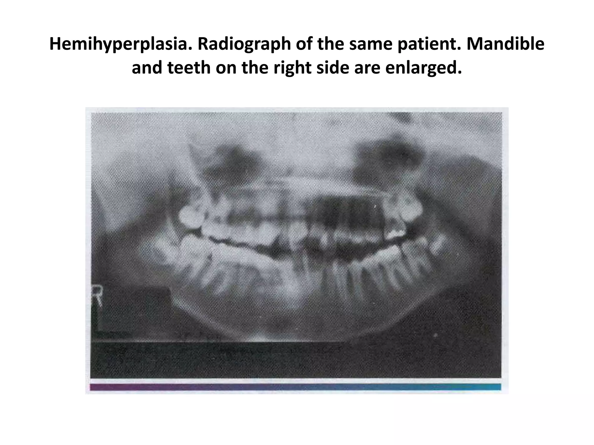 Hemihyperplasia. Radiograph of the same patient. Mandible
and teeth on the right side are enlarged.
 