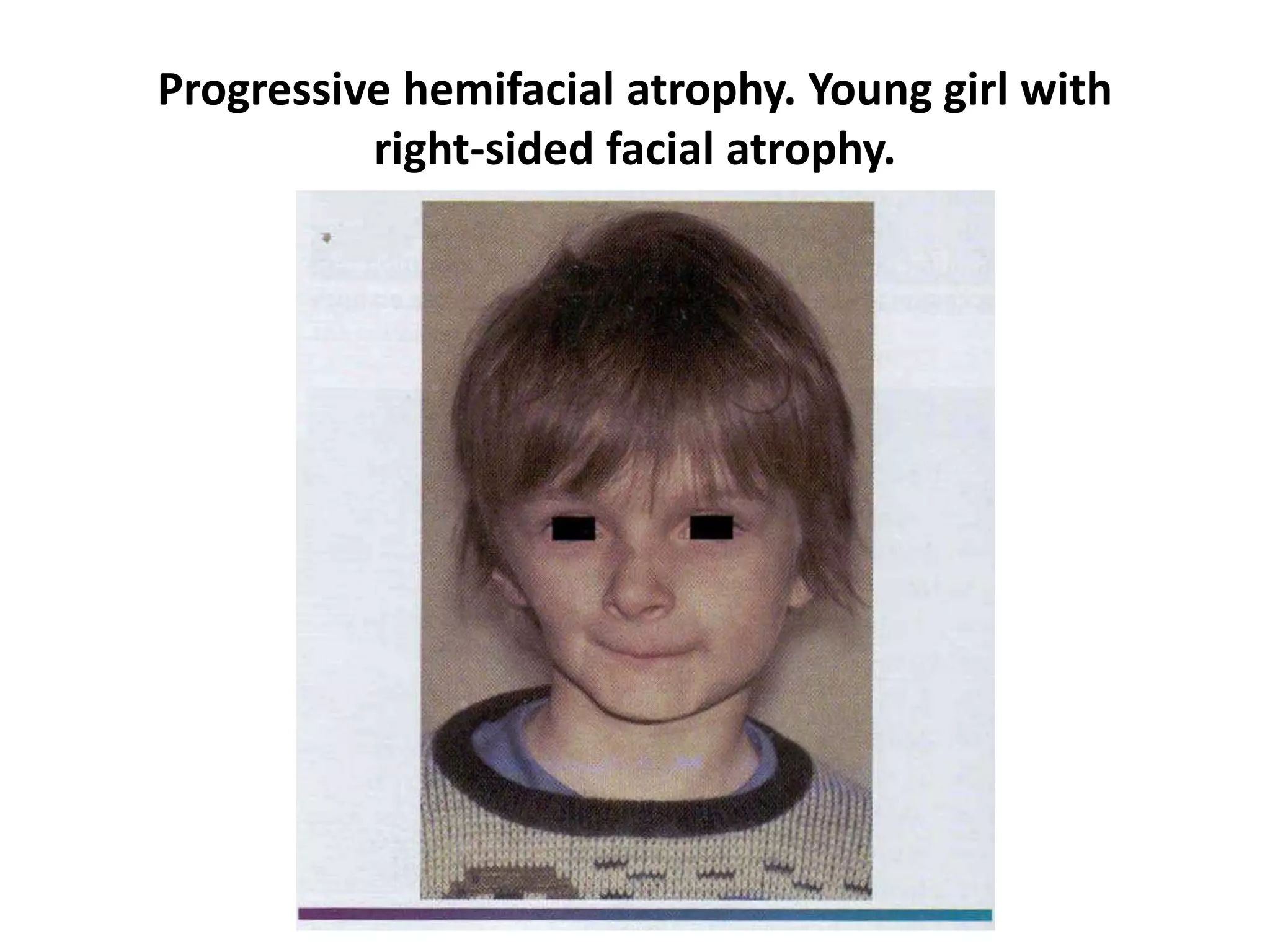 Progressive hemifacial atrophy. Young girl with
right-sided facial atrophy.
 