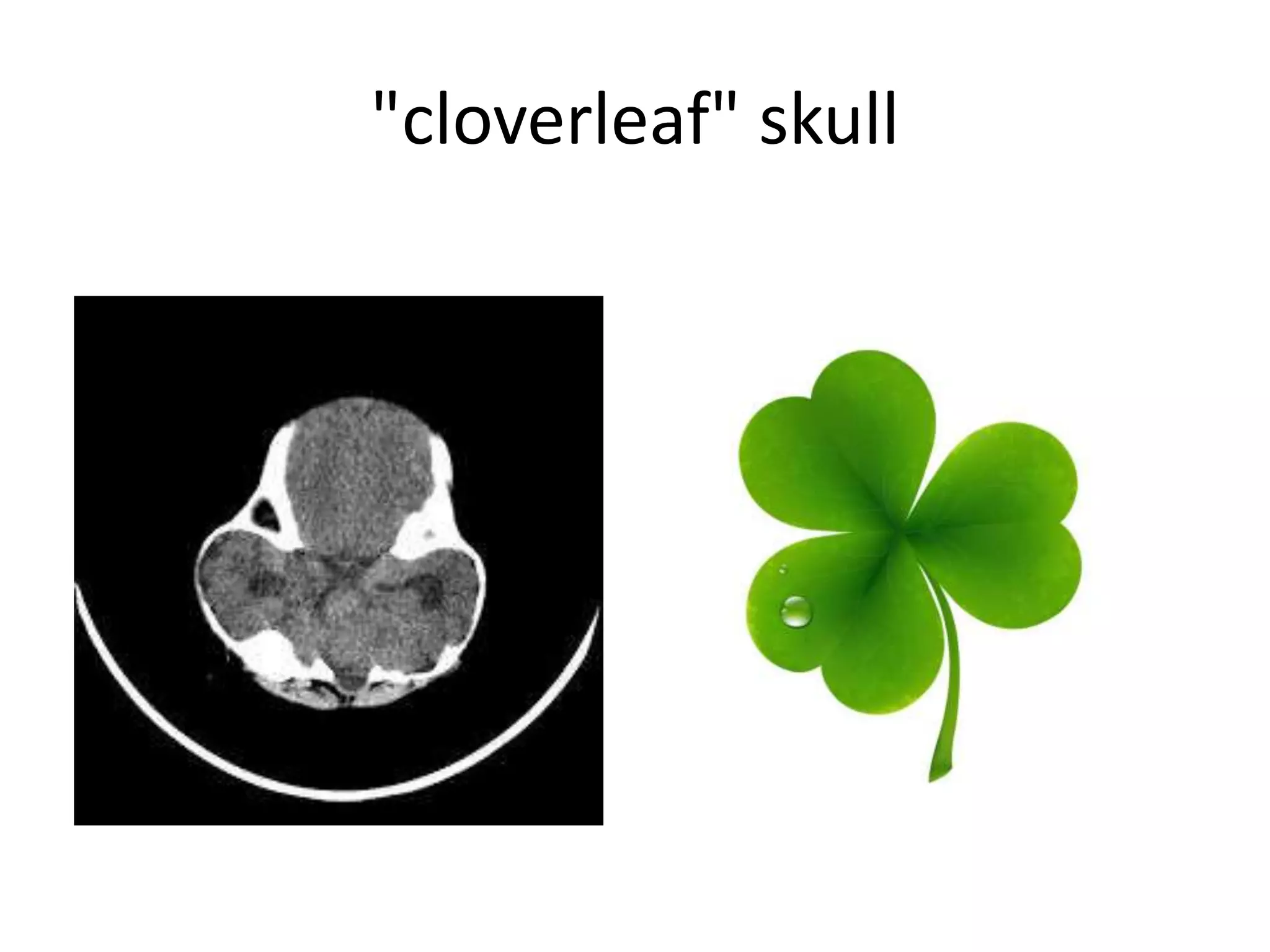 "cloverleaf" skull
 