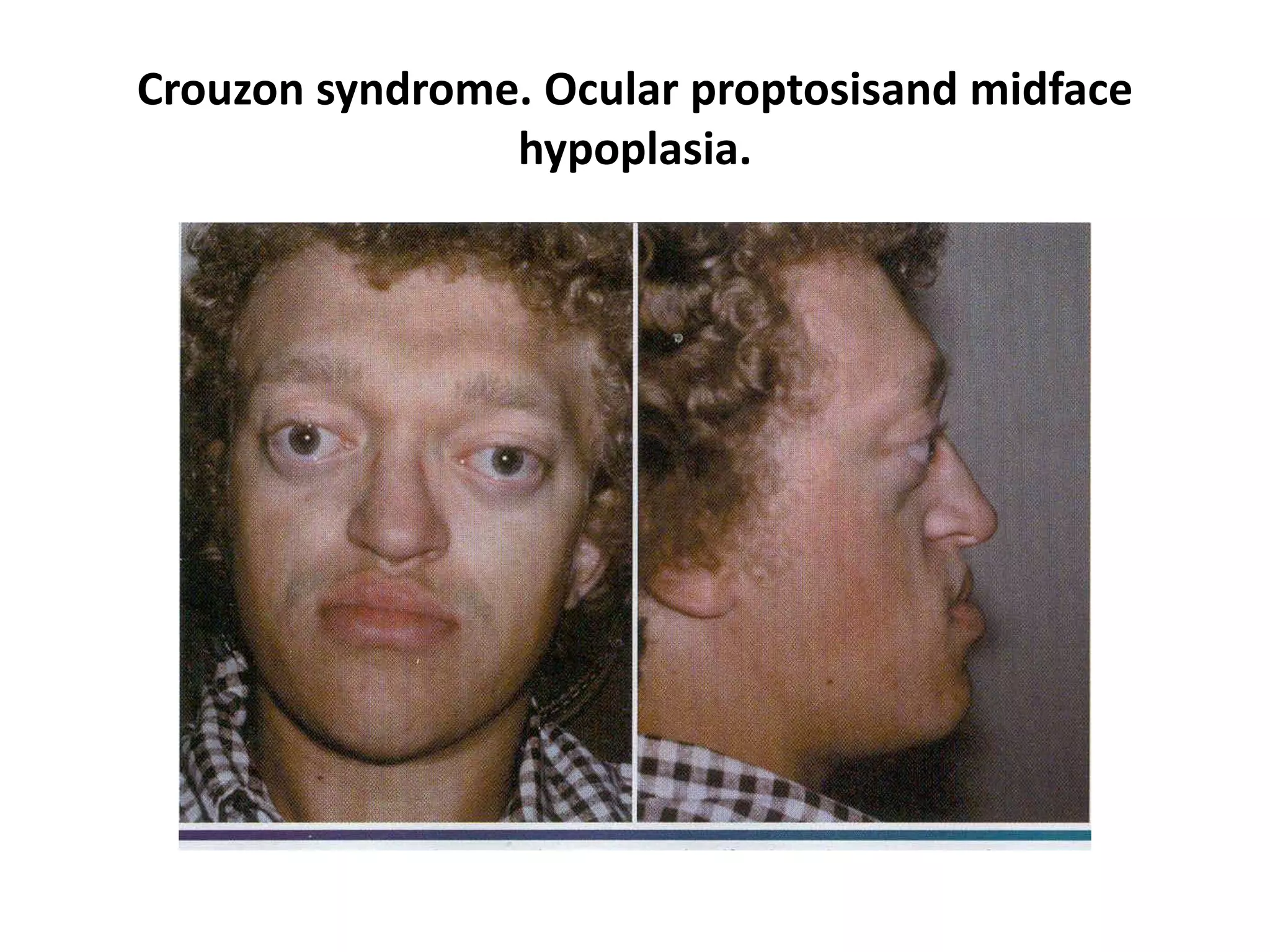 Crouzon syndrome. Ocular proptosisand midface
hypoplasia.
 