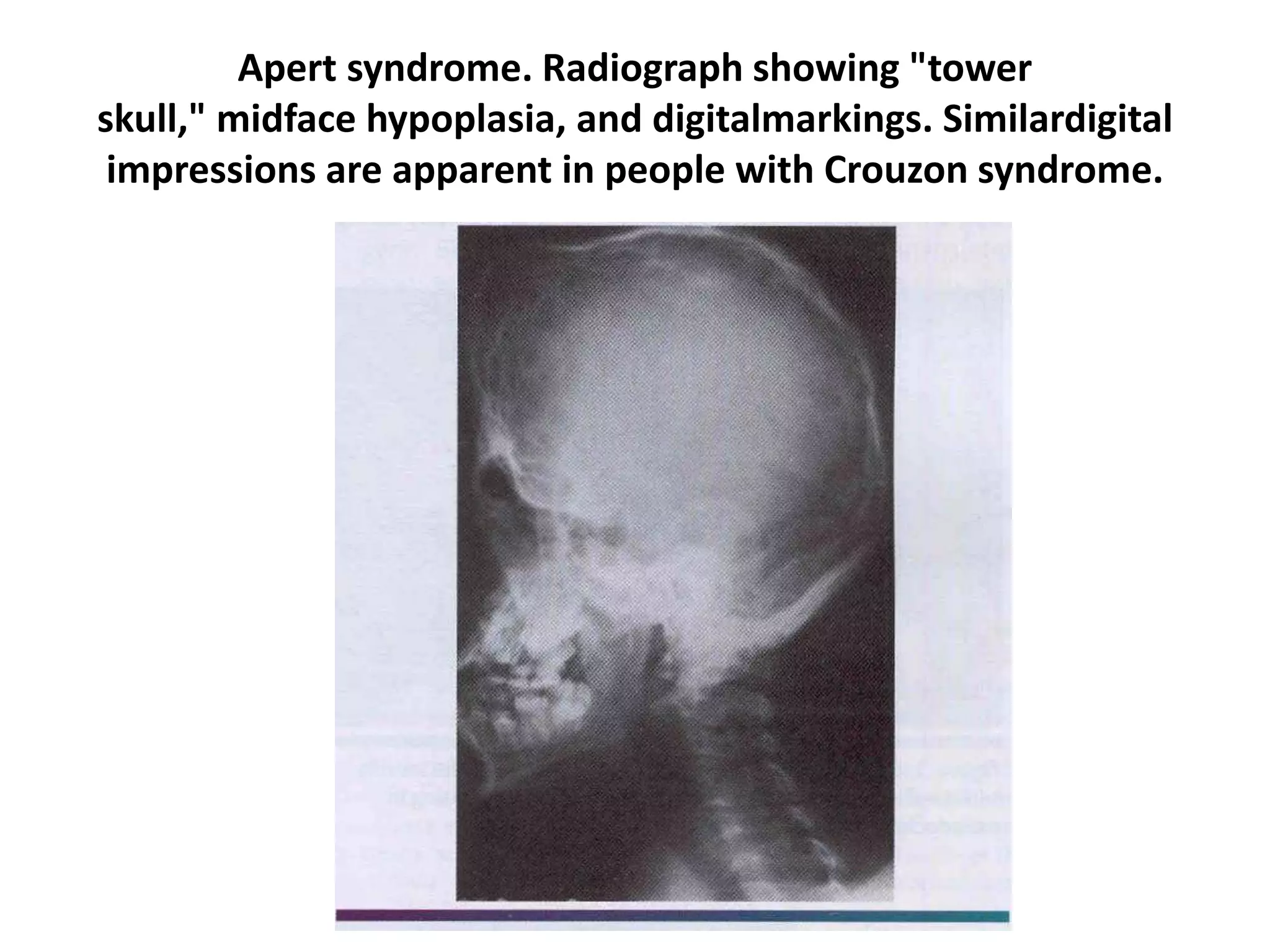 Apert syndrome. Radiograph showing "tower
skull," midface hypoplasia, and digitalmarkings. Similardigital
impressions are apparent in people with Crouzon syndrome.
 