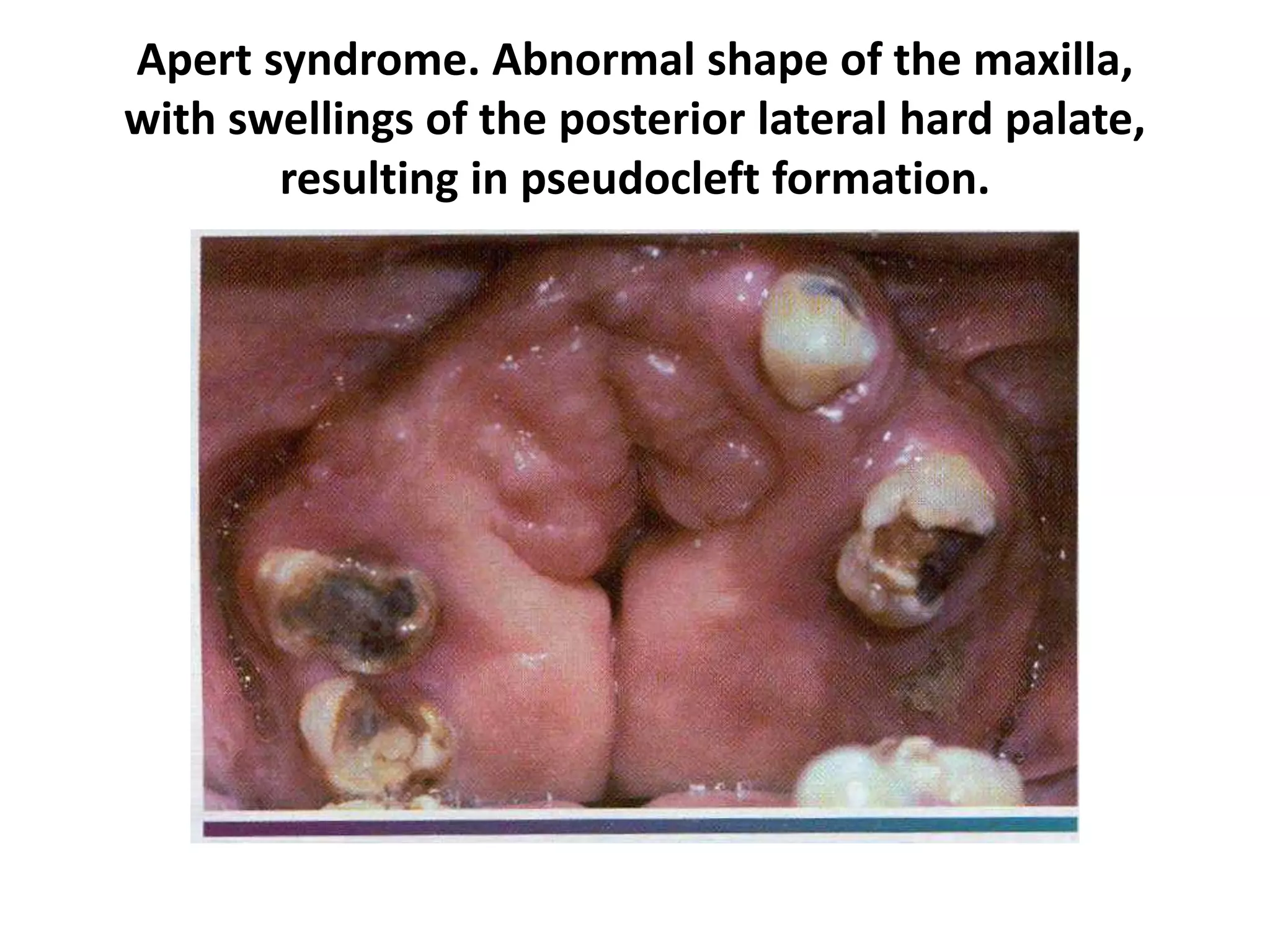 Apert syndrome. Abnormal shape of the maxilla,
with swellings of the posterior lateral hard palate,
resulting in pseudocleft formation.
 