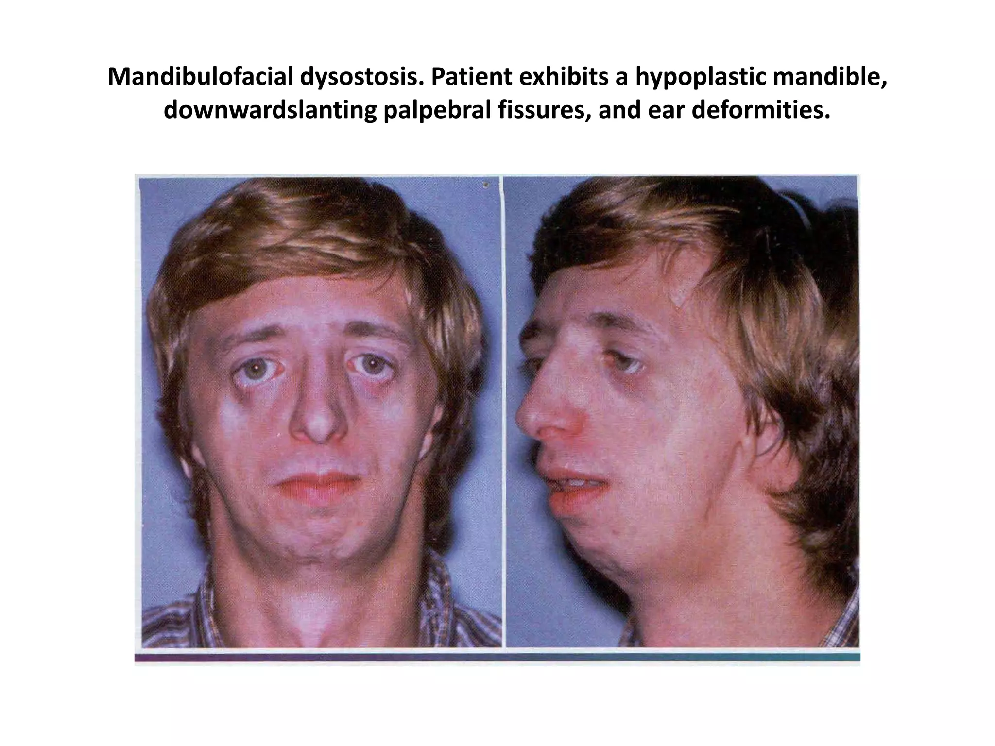 Mandibulofacial dysostosis. Patient exhibits a hypoplastic mandible,
downwardslanting palpebral fissures, and ear deformities.
 