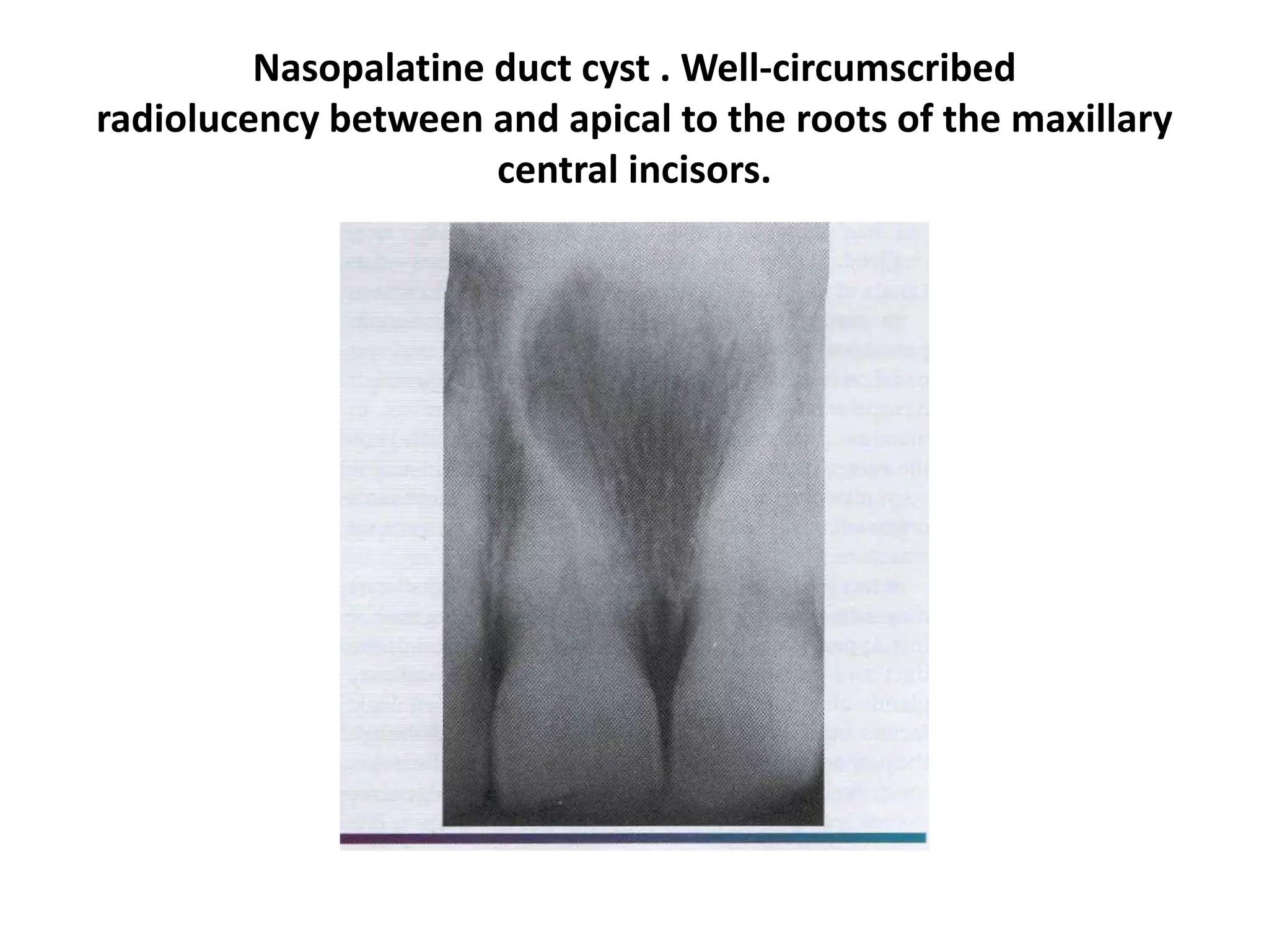 Nasopalatine duct cyst . Well-circumscribed
radiolucency between and apical to the roots of the maxillary
central incisors.
 